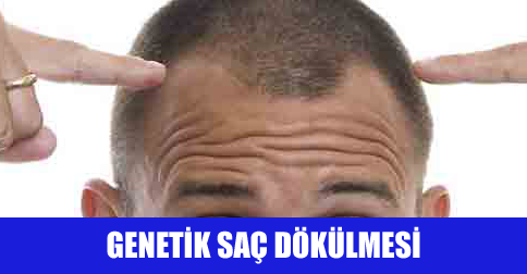 Saç Dökülmesi Genine Sahip Olduğunuzu Nasıl Anlarsınız?